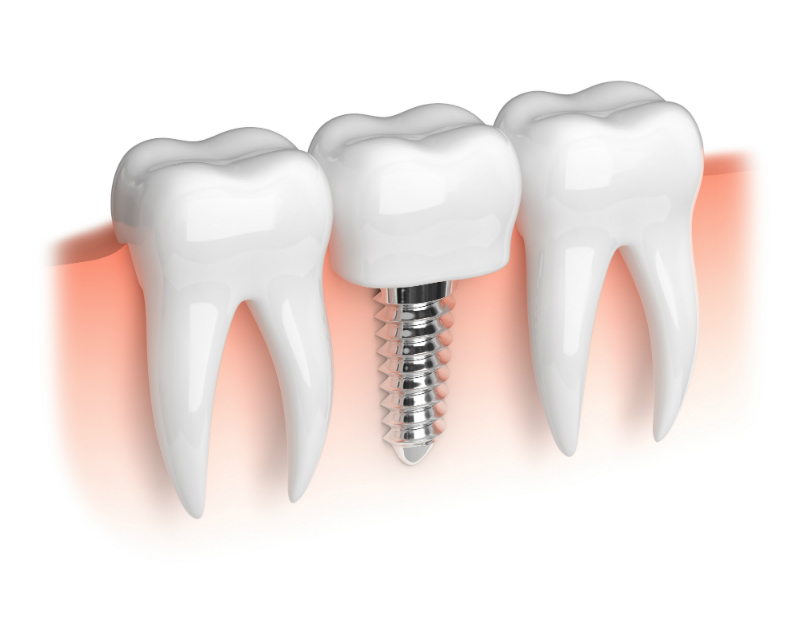 Finding Same Day Urgent Dental Care Solutions in Summerville SC