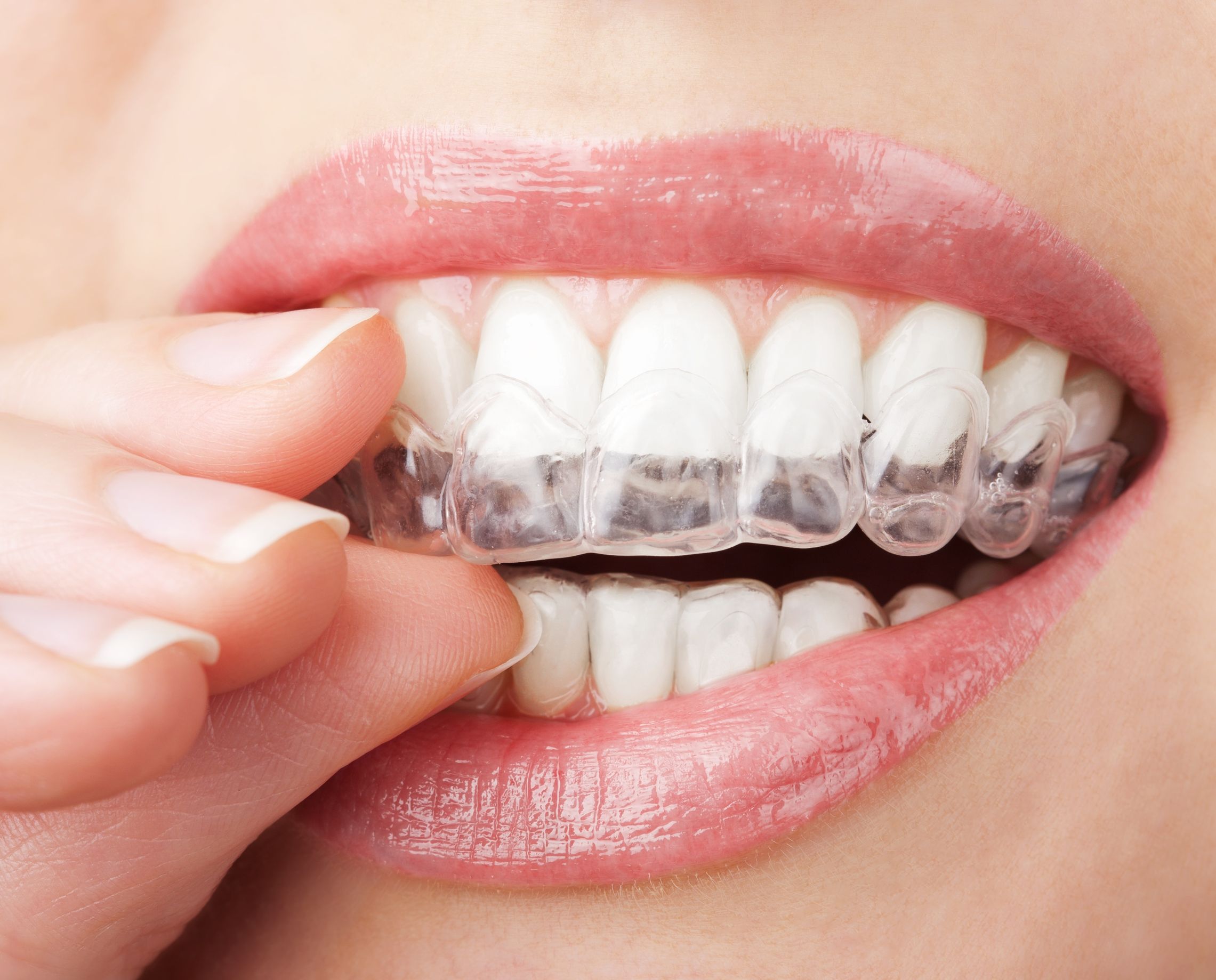 How Dental Invisalign in Long Beach, CA, Enhances Comfort and Flexibility